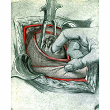1925 DeLEE Cesarean
